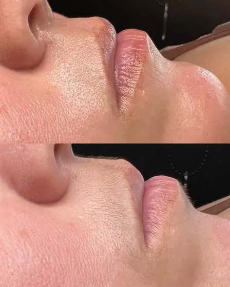 Antes e depois da depilação do buço