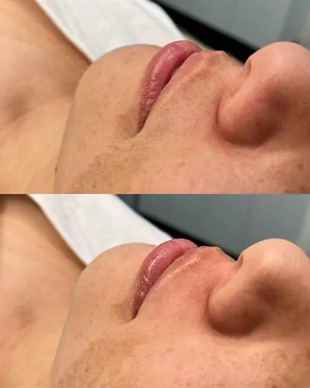 Antes e depois da depilação do buço