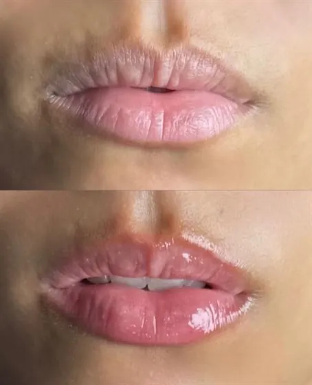 Antes e depois da regeneração labial