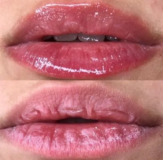 Antes e depois da regeneração labial