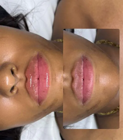 Antes e depois da regeneração labial