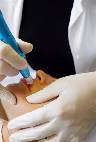 Microagulhamento nos lábios durante a regeneração labial