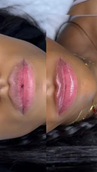 Antes e depois da regeneração labial