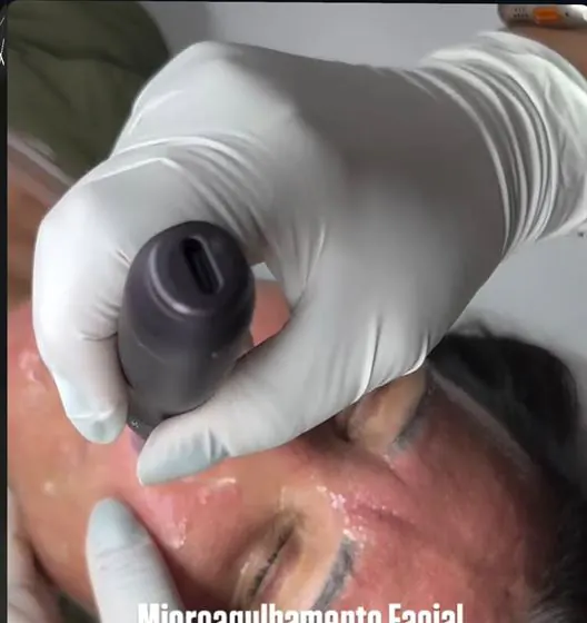 Microagulhamento facial durante o procedimento