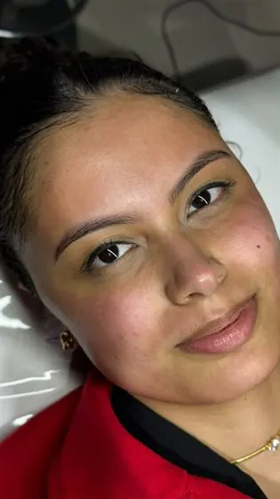Cliente após o microagulhamento facial
