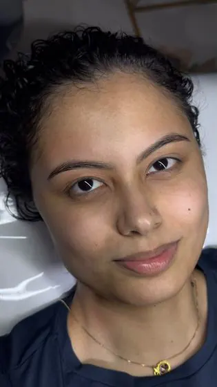 Cliente após o microagulhamento facial
