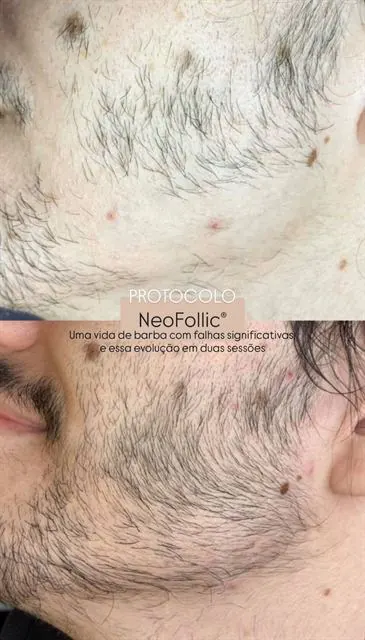 NeoFollic® na barba: falhas e a evolução em duas sessões