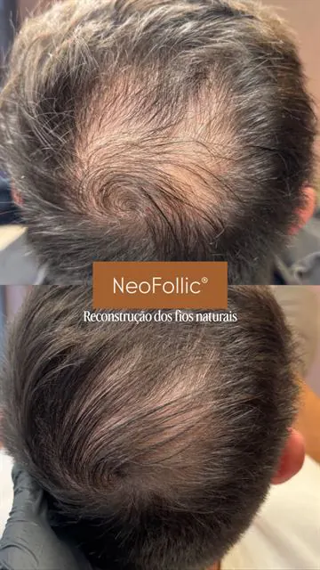 NeoFollic® capilar: antes e depois no couro cabeludo